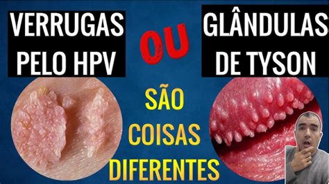 Glândulas de Tyson: o que são, porque aparecem e tratamento